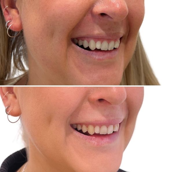 Före- och efterbild på Gummy smile med botox